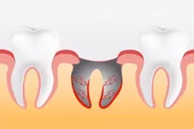 干槽症，特别疼，拔牙后如何预防它？图片
