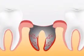 干槽症，特别疼，拔牙后如何预防它？图片