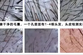 毛囊检测有什么作用？为什么医生要你做毛囊检测？图片