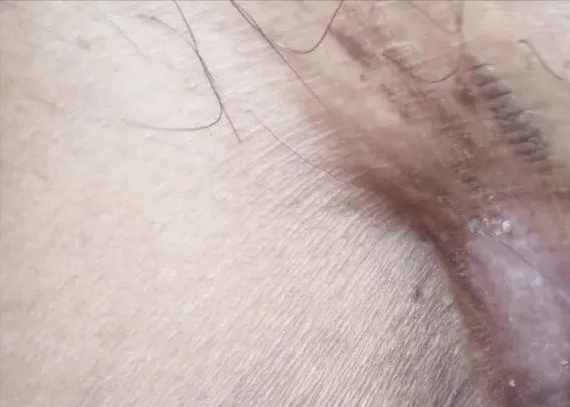 角化棘皮瘤的病理要点
