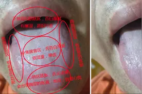 老中医提醒：气滞血瘀的舌象，变成这样危害大！图片