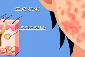 雄激素过多？皮肤出油？毛孔堵塞？感染？痤疮高发的原因是什么？图片