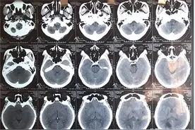 13岁男孩确诊恶性脑胶质瘤，医生提醒：孩子出现这些症状尽早就医图片