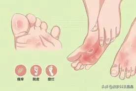 脚趾缝里长水泡，原来是足癣图片