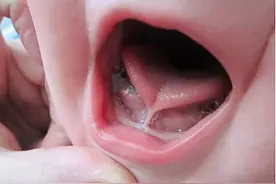 快看看孩子的舌头，有这种情况千万留意！图片