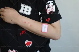 郑州祛疤好医院？手臂烟疤该怎么治疗？图片