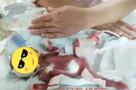 仅400克！滨州超早产儿奇迹存活，126天连闯生死关图片