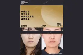 不想正颌？牙齿矫正拯救地包天的颜值，“月亮脸”变成直面型图片