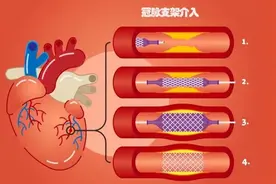心脏放了支架第二天就可以出院？为什么有人放了支架还会心梗？图片