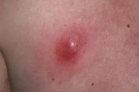 长了皮脂腺囊肿，怎么办？亲身经历告诉你图片