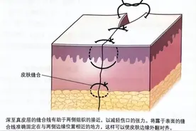 手术缝合线，伤口愈合就功成身退的无名英雄图片
