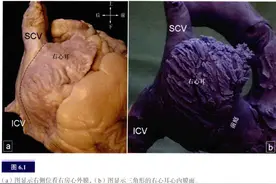 心脏解剖：右心房图片