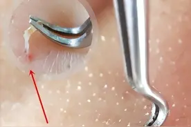 鼻子黑头超级多，草莓一样，挤得出白色的东西，很恶心，怎么办？图片