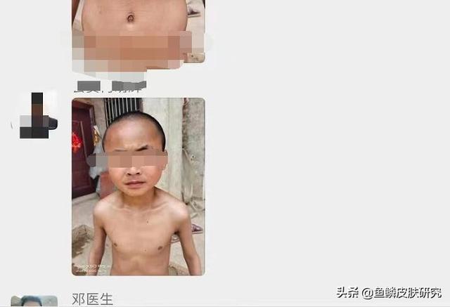 鱼鳞病跟鸡皮肤是一样的时候吗