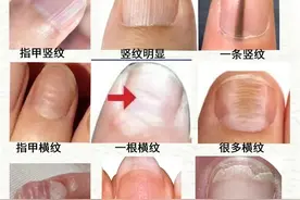 老中医的拿手绝活：只要看指甲、就能知健康，9种异常指甲纹路图片