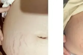 纯天然＝安全？医生：买预防妊娠纹产品，不避开2个坑都是白折腾图片