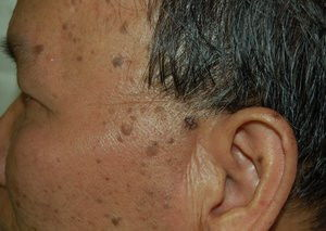 脸上角化栓很厚