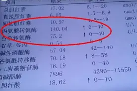 肝功能转氨酶高就是肝硬化？未必，这几个指标才是重点！图片
