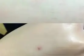 同样是被咬，蚊子包大代表身体虚，小红点说明身体好？图片