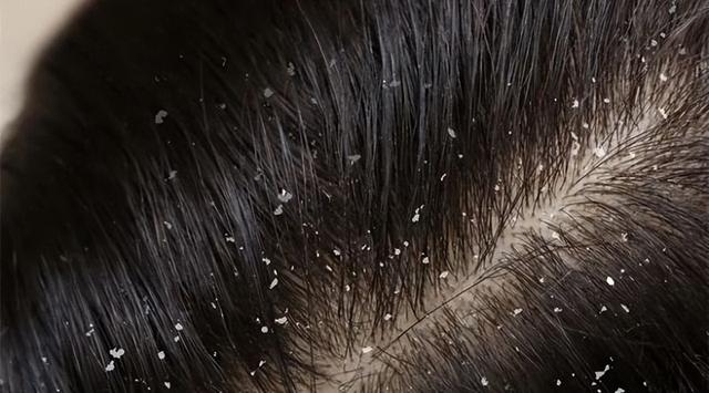 去屑洗发水推荐,雪花头的克星,告别头屑头痒,从"头"开始