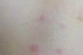 狗狗身上的跳蚤，也会咬人哦图片