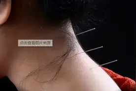 针灸机器人要拯救老中医？专利看针灸、刮痧、拔罐技艺哪家强图片