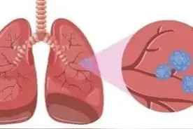 结节、囊肿，消瘰丸三味药为基础方，清热化痰，软坚散结图片