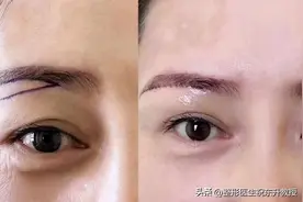 40岁以后把提眉手术做了，才明白的4件事，有点后悔没早做图片