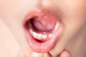 比蛀牙更难搞！孩子长出双排牙，拖得越晚影响越大图片