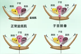 盆底功能障碍——子宫脱垂的治疗方式图片