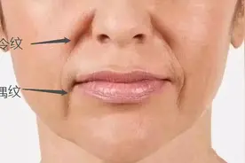 木偶纹做填充还是面部提升？图片