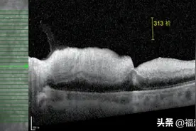 视网膜中央动脉阻塞复通，福州爱尔眼科医院实现新技术新突破图片