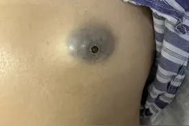 鸡蛋大的粉刺你见过吗？图片