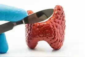 这类甲状腺癌，不会远处转移！图片