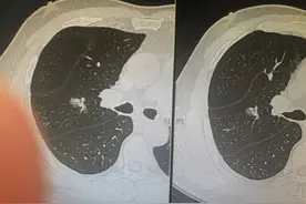 肺磨玻璃结节可能是浸润性黏液肺腺癌吗？这例混磨生长速度快图片