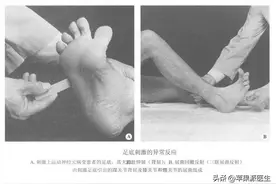 巴宾斯基（Babinski）征怎么查图片