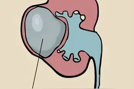 体检中发生率那么高的肾囊肿，到底是不是肿瘤？图片