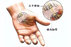 手麻是什么病？该如何就诊？图片