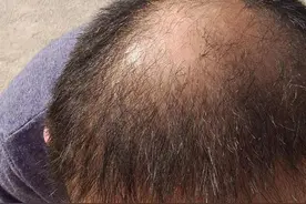 40+男人脱发秃顶米诺地尔使用记录近一个月图片