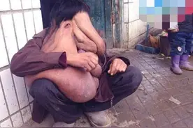 巨型肿瘤让男子痛苦不堪，终日不敢出门，有人欲买其做怪物表演图片