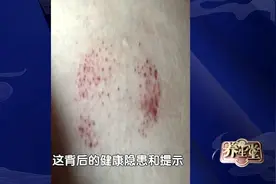 皮肤有这种“小红点”，多半是血瘀！4个中药方，内外同调化血瘀图片