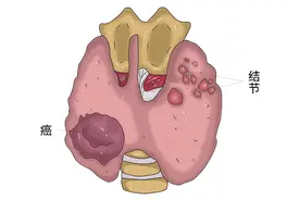 甲状腺癌来时，身体可能会有四点症状，甲状腺结节和癌有关系吗？图片