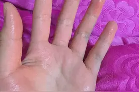 手汗症的危害有多大？图片