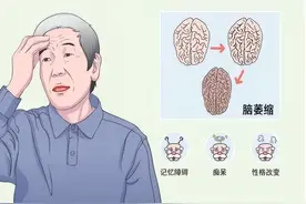 为何中国脑梗越来越多？医生：除了补充叶酸，做好这3点更重要图片