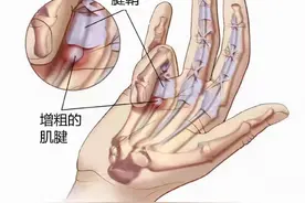 中老年女性常手指疼痛、肿胀，是腱鞘炎吗？该怎么办？告知您图片