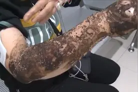 女子江边散步被蛇咬，几分钟就昏迷手肿如馒头，被蛇咬到该怎么做图片