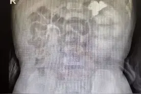 宝宝先天长了3个肾，还做了手术，孩子出现这些症状记得筛查图片