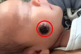 17天新生儿右脸肉芽肿溃烂，江西省儿童医院一小时手术高效解决图片