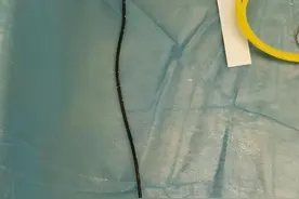 患者：乖乖，一个月又长了这么多结石！医生一次不顺利的拔管经历图片