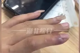 女子拔倒刺后致手指骨髓炎，目前需要进行刮骨手术，处理不当或面临截肢图片